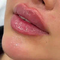 ژل و بوتاکس