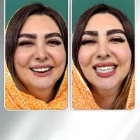 ایمپلنت دندان بدون پیش پرداخت