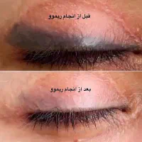 ریموو ریمو پاک کردن تتو تاتو پاک کردن