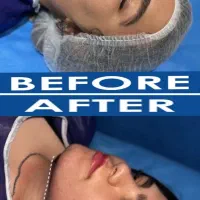 جشنواره ساکشن شکم ، پهلو و غبعب|خدمات آرایشگری و زیبایی|کرمانشاه, |دیوار