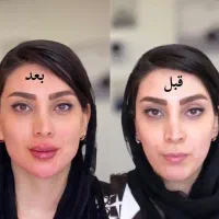 جشنواره یلدایی تزریق ژل لب،بوتاکس توسط پزشک متخصص