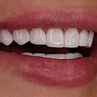 دندانپزشکی و زیبایی لمینت کامپوزیت روکش