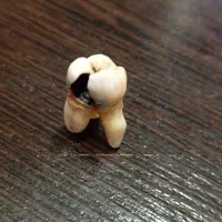 دندان سالم فقط یه ریشش  به اعصاب رسیده