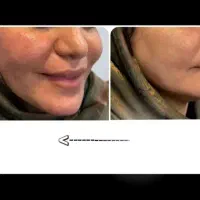 تزریق ژل،فیلر وجوانساز توسط پزشک /خدمات لیفت صورت