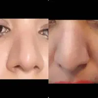 کوچک کردن بینی بدون جراحی و درد