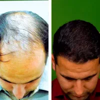 کاشت مو شیرازی vip فول تراکم تعرفه استثنایی|خدمات زیبایی و سلامت|تهران, پاسداران|دیوار