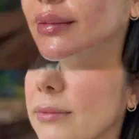 آموزش ژل و بوتاکس مناسبترین قیمت با مربی با تجربه
