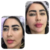 ژل و بوتاکس اصل طرح تخفیف بهاری