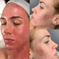آموزش فیشال و پاکسازی تخصصی