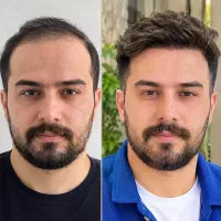کاشت مو
