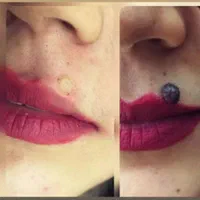 ۱۵٪تخفیف لیزر موهای زائد الکترولیز خالبرداری کربن|خدمات آرایشگری و زیبایی|فولادشهر, B5|دیوار