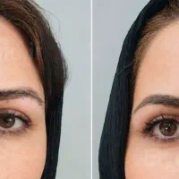 بلفارو پلاستی ۷ تومن کاشت ابرو و مو ساکشن|خدمات زیبایی و سلامت|کرج, اتحاد|دیوار