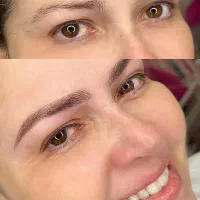 میکروبلیدینگ و کراتین