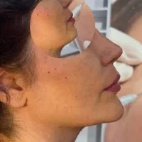 اف ژل لب وآف بوتاکس درمطب پزشک|خدمات آرایشگری و زیبایی|مشهد, احمدآباد|دیوار