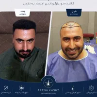 جشنواره تابستانه کاشت موفول تراکم تخفیف ویژه همدلی
