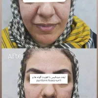 تزریق تمام اقساط بدون پیش پرداخت ژل،بوتاکس،مزو|خدمات آرایشگری و زیبایی|قم, بکایی|دیوار