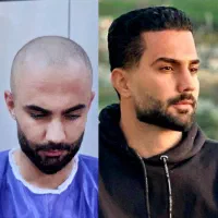 کاشت مو وابرو در تهران و شیراز