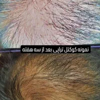 ریموو تتو با اشانتیون  در کلینیک زیبایی|خدمات آرایشگری و زیبایی|تهران, تهرانپارس غربی|دیوار