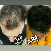 انواع مشکلات مو با گیاهان دارویی