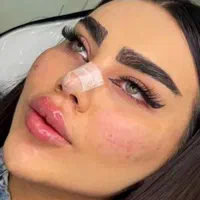 تزریق ژل بوتاکس چال لپ گونه پرسینگ آنزیم در کلینیک