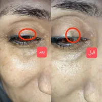 لیزر خال /میخچه زگیل/ ژل بوتاکس|خدمات آرایشگری و زیبایی|قم, صفائیه|دیوار