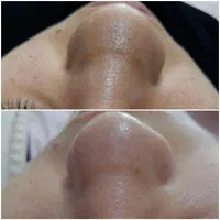 انجام کلیه خدمات پاکسازی پوست بصورت کاملا تخصصی|خدمات آرایشگری و زیبایی|سرپل ذهاب, |دیوار