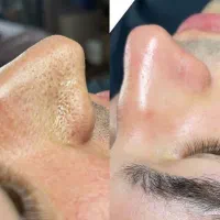 پاکسازی صورت آقایان رفع آفتاب سوختی و جوش سریع