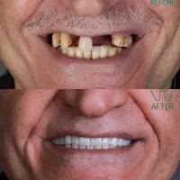 ایمپلنت دیجیتال اقساطی بدون سود تحت بیهوشی|خدمات آرایشگری و زیبایی|مرودشت, ژیان|دیوار