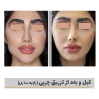 طرح اقساطی ویژه تزریق فول فیس فیلر/بایوفت و نانوفت