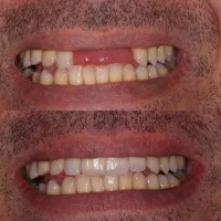 ایمپلنت کامپوزیت ارتودنسی روکش لمینت|خدمات آرایشگری و زیبایی|ایلخچی, |دیوار