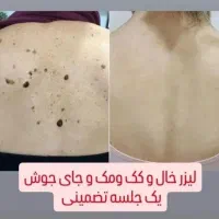 جشنواره درمان تضمینی کک و مک/ زگیل / فقط در 1 جلسه