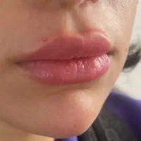 تزریق ژل|خدمات آرایشگری و زیبایی|یاسوج, |دیوار