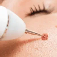 خدمات خال برداری ،مزوتراپی ،پیرسینگ ، میکرونیدلینگ