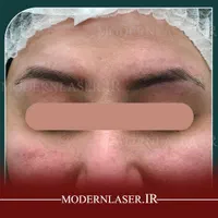 ریموو انواع تتو و خالکوبی بدون هیچ اثری توسط پزشک|خدمات آرایشگری و زیبایی|اصفهان, سعادت‌آباد|دیوار