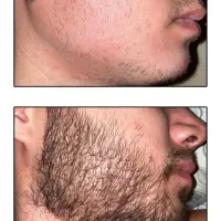 رویش ریش 25روزه تضمینی