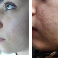 جوانسازی،لیپوساکشن شکم و پهلو،ترنسفر به باسن