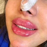 تزریق فیلر صورت مطابق المانهای زیبایی شناسی|خدمات آرایشگری و زیبایی|قرچک, پویینک|دیوار