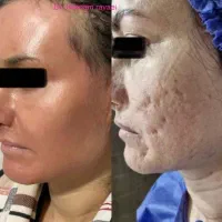 درمان و لیزر تضمینی کک و مک و لک فقط در 1 جلسه|خدمات آرایشگری و زیبایی|اصفهان, لاله|دیوار