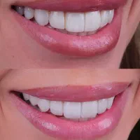 کامپوزیت دندان و خدمات درمانی دندان|خدمات زیبایی و سلامت|مشهد, هنرستان|دیوار