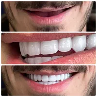 دندان مصنوعی‌ اقساط 12ماهه پیش پرداخت فقط 6میلیون