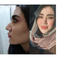 عمل بینی فقط با 30 ملیون|خدمات آرایشگری و زیبایی|شیراز, قصرالدشت|دیوار