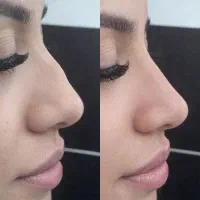لیفت بینی در خانه بدون هیچ درد و عوارضی