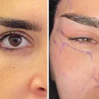 بلفارو/غبغب/سانترال/چشم گربه ایی/فیلر بادی و بکینی|خدمات آرایشگری و زیبایی|اهواز, کیانپارس |دیوار