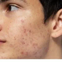 جوش یا لک و جای جوش در صورت و بدن|آرایشی، بهداشتی، درمانی|شیراز, لشکری‎|دیوار
