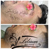 رفع جای جوش تضمینی|خدمات آرایشگری و زیبایی|اصفهان, وحید|دیوار