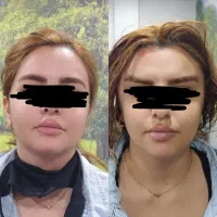 تزریق چربی و فیلربیکینی بانوان و آقایان/ساکشن چربی|خدمات آرایشگری و زیبایی|سقز, |دیوار