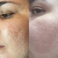 برداشت لک و فرو رفتگی صورت