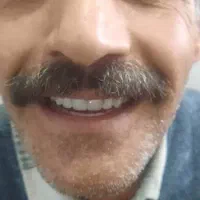 دندان مصنوعی در محل شما با کیفیت تضمینی