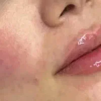 تخفیف ویژه بوتاکس و کارای پوستی فیلر فقط 1200