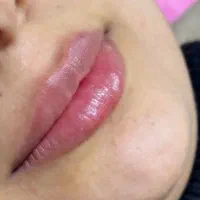 تزریق ژل و بوتاکس و پی آر پی و پیرسینگ